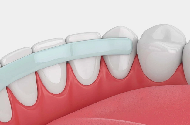 dental bonding long beach ca