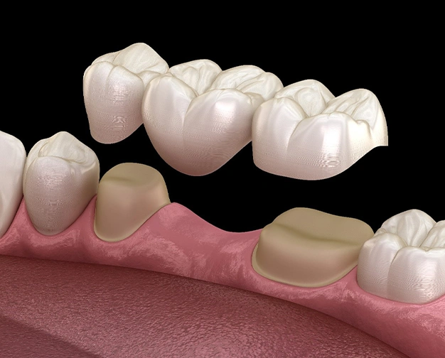 dental crowns and bridges