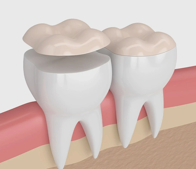 dental inlays and onlays long beach