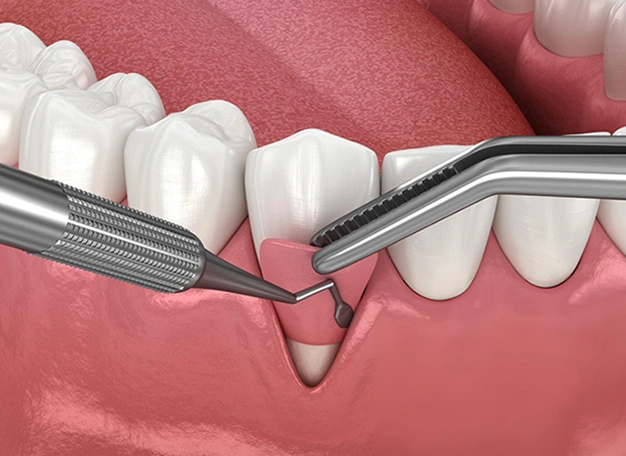 tissue grafting long beach ca