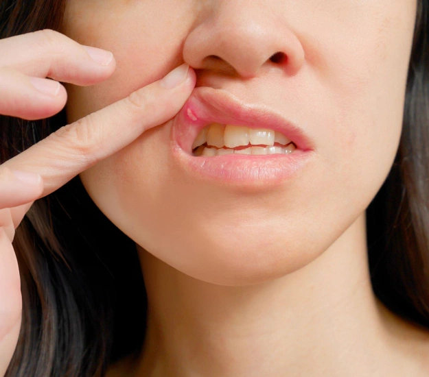 laser canker sore treatment long beach ca