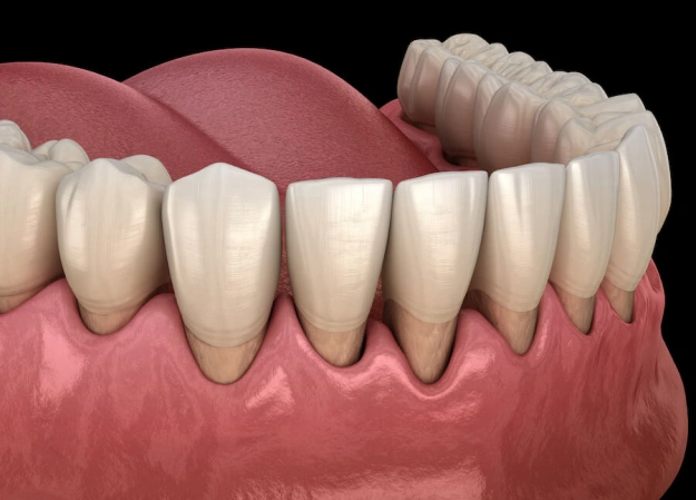 scaling & root planing long beach ca
