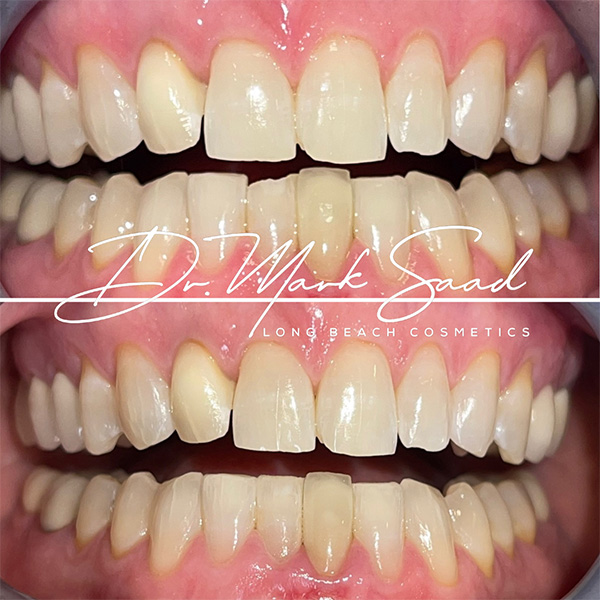 Smile makeover before and after