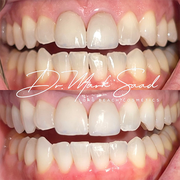 dental transformation with before-and-after results