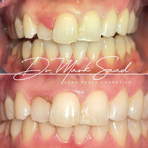 smile transformation before and after