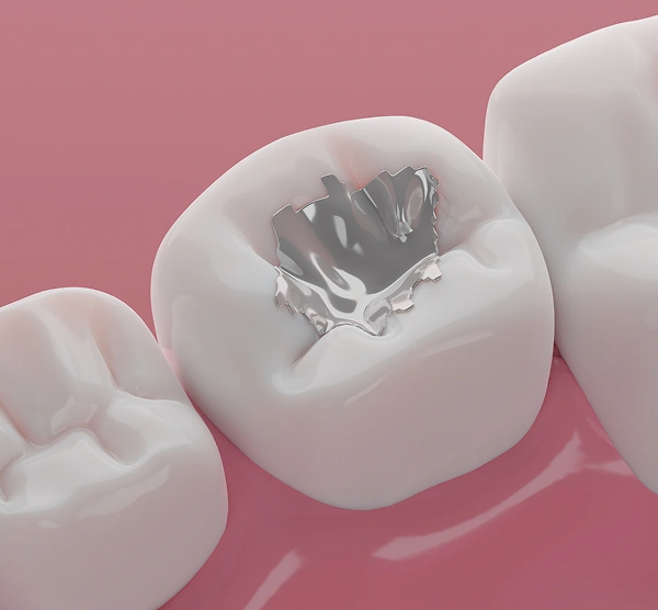 Dental Fillings