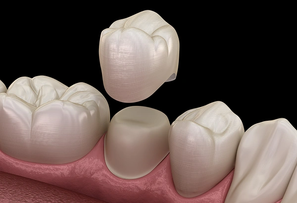 Porcelain Crowns